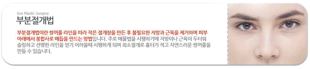 부분절개법:부분절개법이란 쌍꺼풀 라인을 따라 작은 절개창을 만든 후 불필요한 지방과 근육을 제거하며 피부 아래에서 봉합사로 매듭을 만드는 방법입니다. 주로 매몰법을 시행하기에 지방이나 근육이 두터워 슬림하고 선명한 라인을 얻기 어려울때 시행하게 되며 최소절개로 흉터가 적고 자연스러운 쌍꺼풀을 만들 수 있습니다.