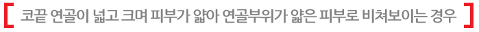 코끝 연골이 넓고 크며 피부가 얇아 연골부위가 얇은 피부로 비쳐보이는 경우