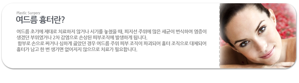 여드름 흉터란?
 여드름 초기에 제대로 치료하지 않거나 시기를 놓쳤을 때, 피지선 주위에 많은 세균이 번식하여 염증이 생겼던 부위였거나 2차 감염으로 손상된 피부조직에 발생하게 됩니다.
 함부로 손으로 짜거나 심하게 곯았던 경우 여드름 주위 피부 조직이 파괴되어 흉터 조직으로 대체되어 흉터가 남고 한 번 생기면 없어지지 않으므로 치료가 필요합니다.